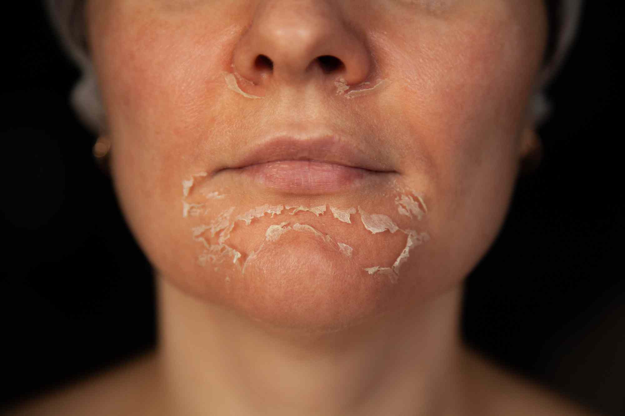 Le Peeling Clermont Ferrand 63 Dr Isabelle GOUYON